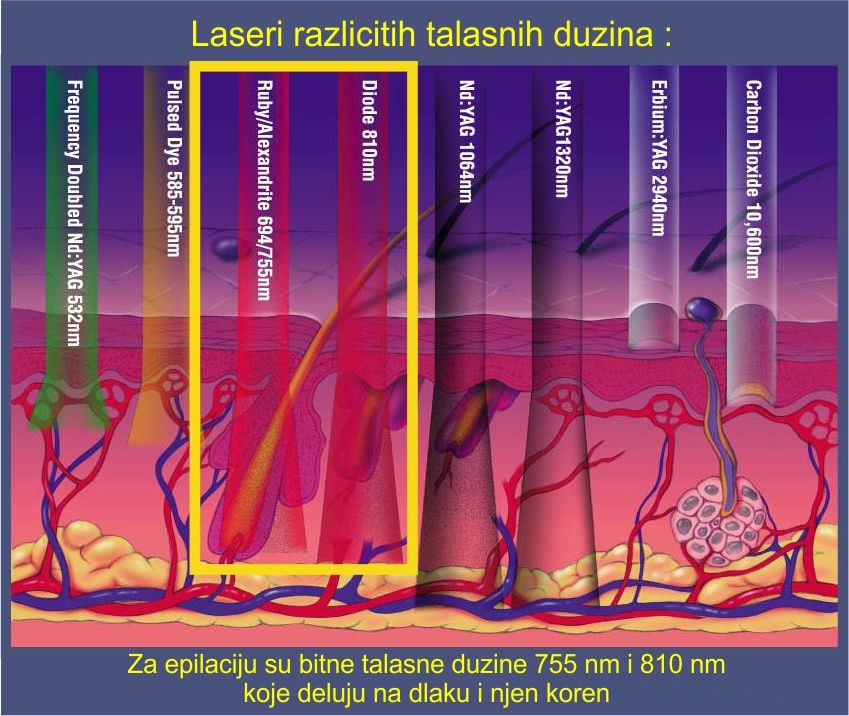 Laserske duzine.jpg